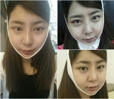 韩国长曲线下颌角手术案例术后第四周