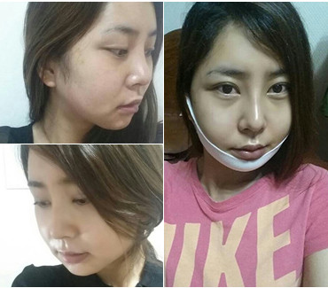 韩国下颌角整形案例术后第三周
