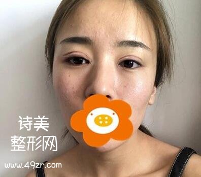 深圳艺星牛克辉医生双眼皮手术术后半个月