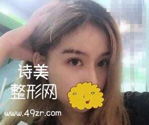 深圳天丽医疗美容双眼皮案例