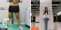 北京东方和谐冯斌吸脂价格表·案例图