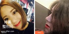 南昌同济医院做鼻子怎么样？价格表及真人案例分享