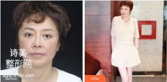 云大医院整形外科打玻尿酸多少钱?价格表及案例一览