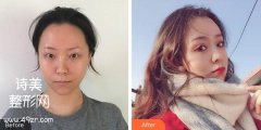 徐州二院整形科价格表·眼部手术案例图分享