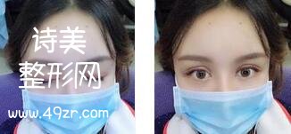 四川军大医学研究所附属医院双眼皮+面部吸脂案例