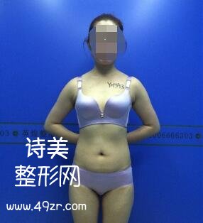 北京英煌整形梁耀婵自体脂肪丰胸案例