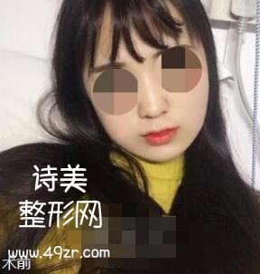 上海首尔丽格整形朴兴植双颚手术案例