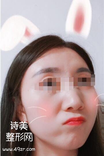 北京紫美韵整形郝创做面部吸脂案例