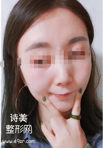 北京紫美韵整形郝创做面部吸脂案例